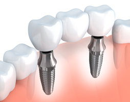 Bell Yard Dental Implants